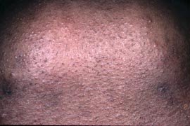 DARK SKIN - After