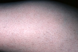 Right calf - After