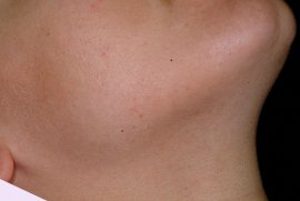 Face and neck of 25 year old female - After