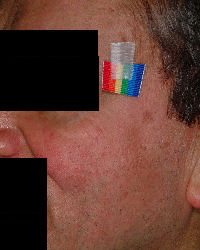 Left Cheek: 54 y/o male - After