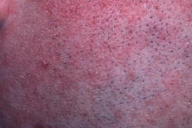 Rosacea, with increased blood vessels - After